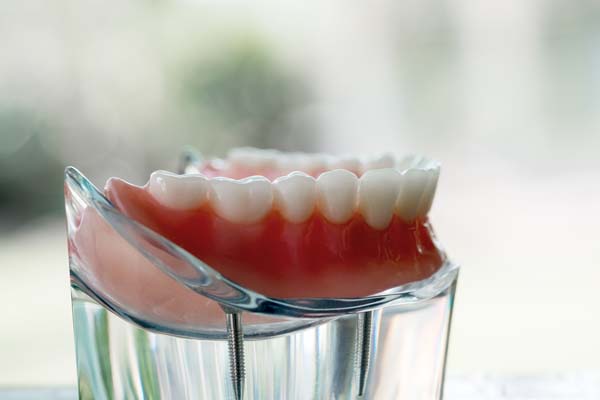 When Are Dentures Recommended?
