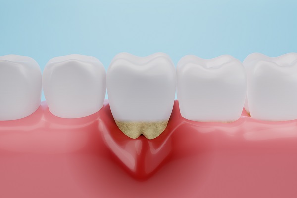 Why Gum Disease Prevention Is So Important