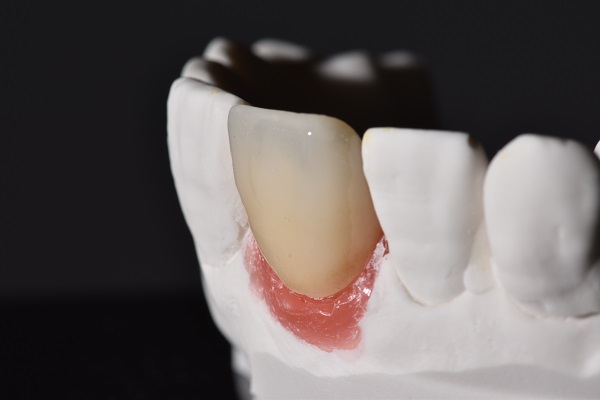 The FAQs Of Zirconia Crowns